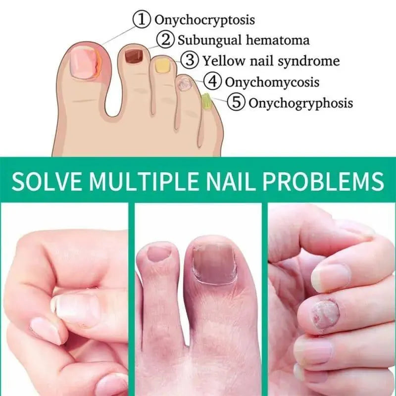 Nail Fungal Treatment Nail Repair Essences Serum