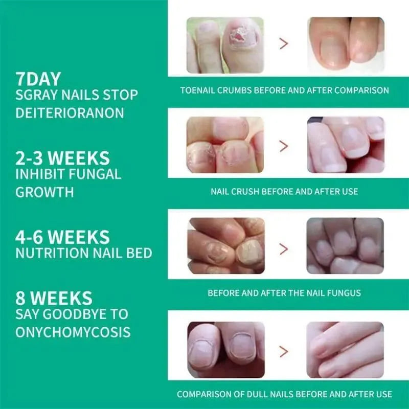 Nail Fungal Treatment Nail Repair Essences Serum